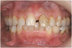 ハイブリッドレジン充填の症例1の治療前