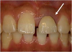 ハイブリッドレジンとセラミック差し歯の症例1の治療前
