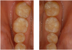 虫歯治療　（ＭＩ）の症例1の治療後