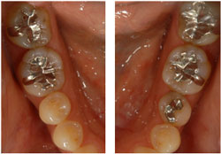 虫歯治療　（ＭＩ）の症例1の治療前