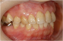 フルジルコニアの症例1の治療前