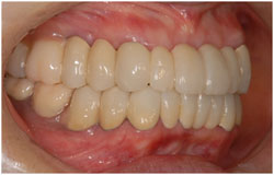 歯周病治療　抜かないための治療の症例1の治療後