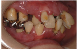 歯周病治療　抜かないための治療の症例1の治療前