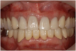 歯周病治療　抜かないための治療の症例2の治療後