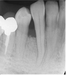 歯周骨再生療法GTRの症例1の治療後