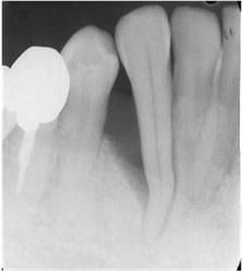 歯周骨再生療法GTRの症例1の治療前