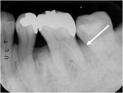 歯周組織再生療法ＧＴＲ　（根分岐部病変）の症例1の治療後