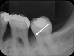 歯周組織再生療法GTR　（根分岐部病変）の症例1の治療前