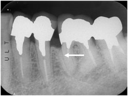 歯周組織再生療法ＧＴＲの症例2の治療後