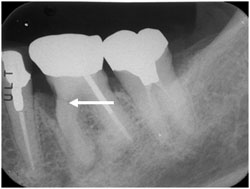 歯周組織再生療法ＧＴＲの症例2の治療前