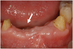 歯周組織再生療法の症例1の治療後