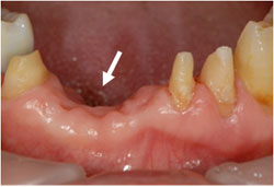 歯周組織再生療法の症例1の治療前