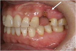 歯周組織再生療法の症例2の治療前
