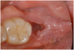 痛くない抜歯の症例1の治療後