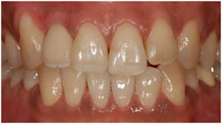 インプラントの特徴　健康な歯を削らないの治療後