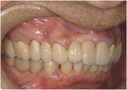 インプラントの特徴自分の歯と同じように何でも食べられるの治療後