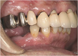インプラントの特徴　自分の歯と同じように何でも食べられるの治療前