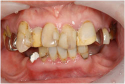 インプラントと総合治療の治療前