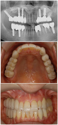 インプラントが支える豊かな人生の治療後