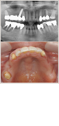 インプラントが支える豊かな人生の治療前