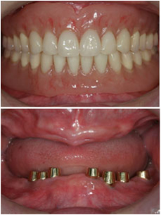 インプラントマグネット入れ歯の症例1の治療後