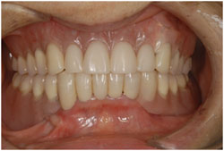 インプラントマグネット入れ歯の症例2の治療後