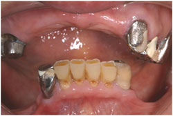 インプラントマグネット入れ歯の症例2の治療前