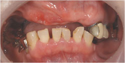 咀嚼障害　インプラントと入れ歯の症例1の治療前