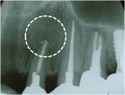 感染性根尖歯周炎の症例1の治療後