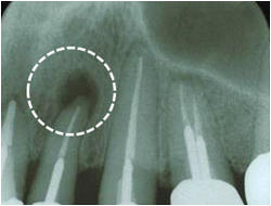 感染性根尖歯周炎の症例1の治療前