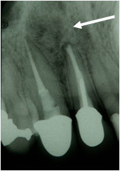 感染性根尖歯周炎の症例2の治療後