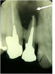 感染性根尖歯周炎の症例2の治療前