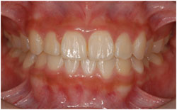 矯正治療　叢生・乱杭歯の症例1の治療後
