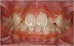矯正治療　叢生・乱杭歯の症例1の治療前
