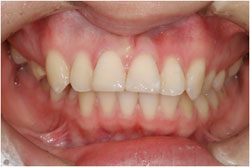 歯牙破折の症例1の治療後