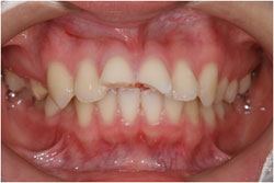 歯牙破折の症例1の治療前
