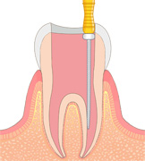 根管治療