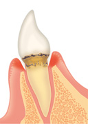 歯周病の進行具合